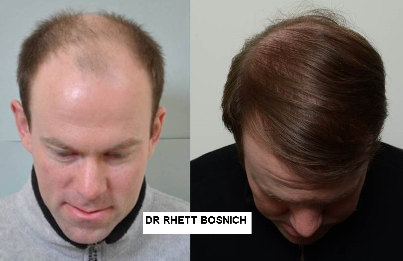 how to stop receding hairline and regrow hair naturally
